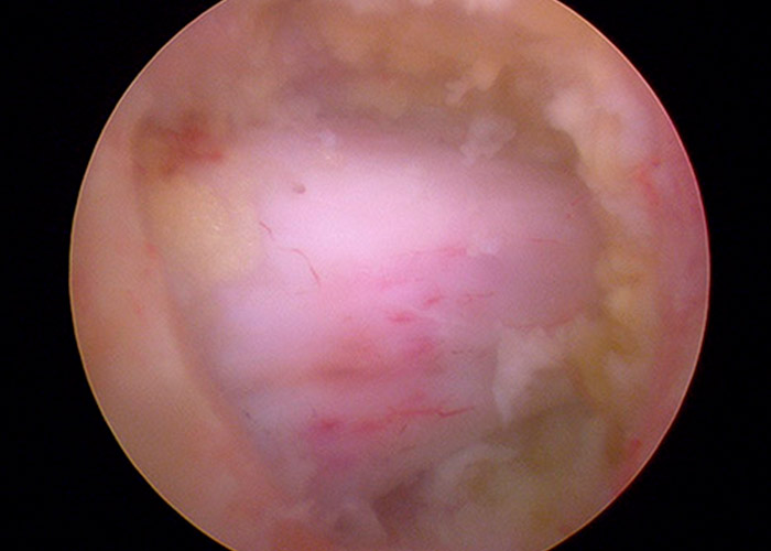 postoperatorio-laminectomia-instituto-CAC