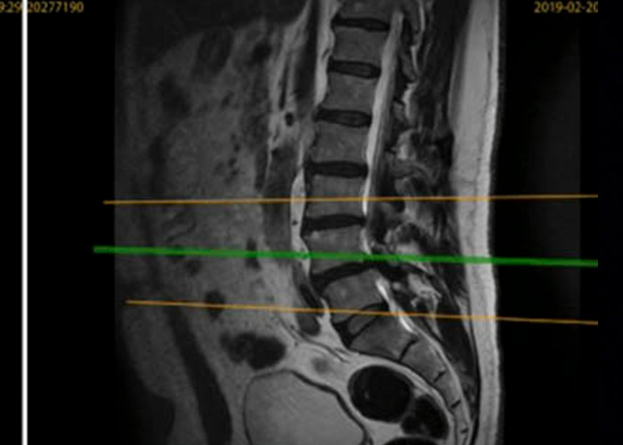 postoperatorio-recidiva-hernia-discal-en-madrid