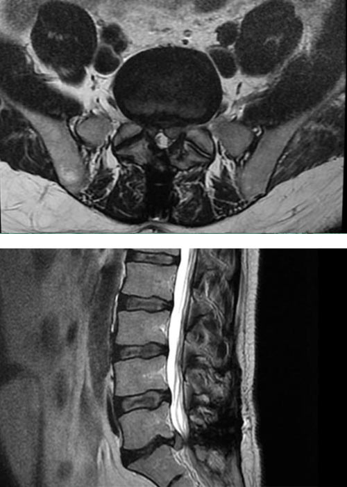 preoperacion-recidiva-hernia-discal-en-madrid