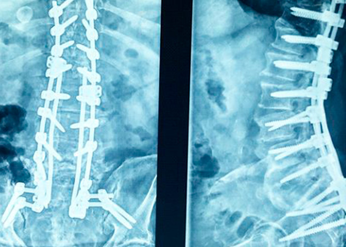 preoperatorio-cirugia-de-columna-vertebral-en-madrid