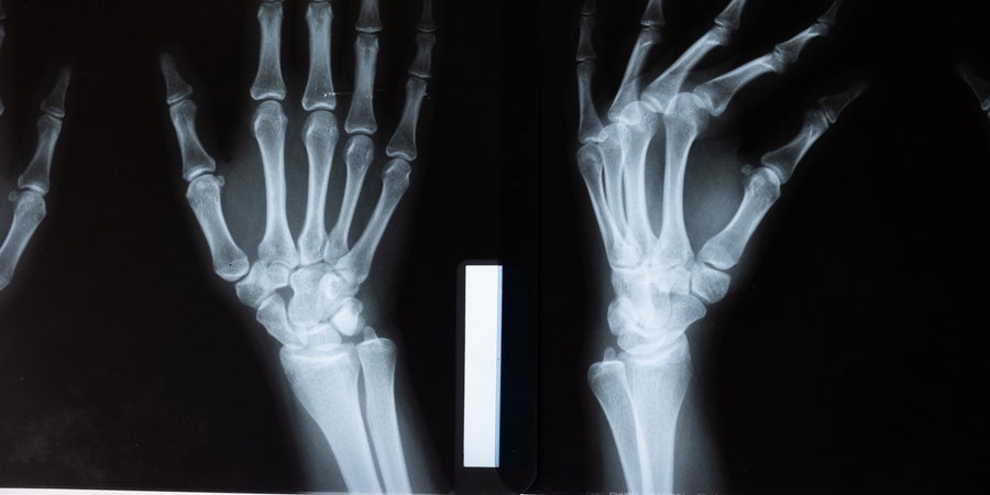 prevenir-pérdida-masa-ósea