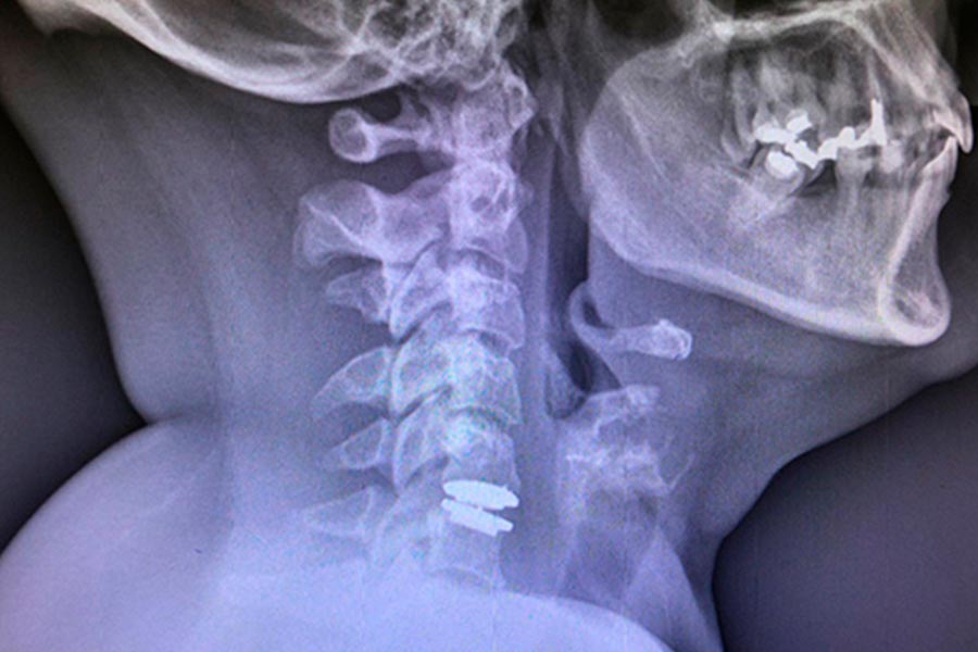 protesis cervical movil