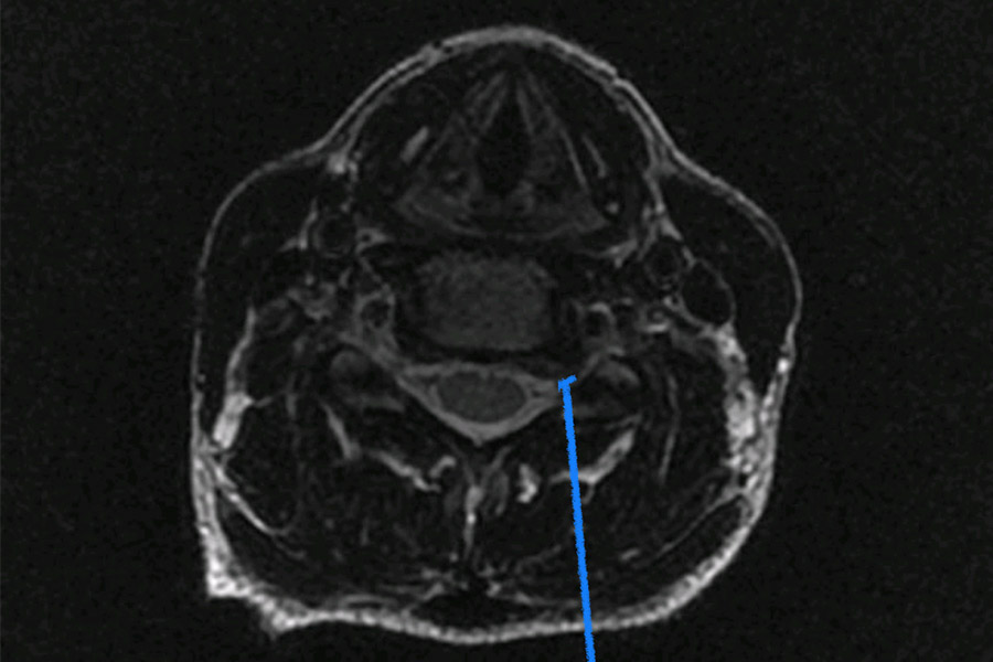 Protesis cervical operacion