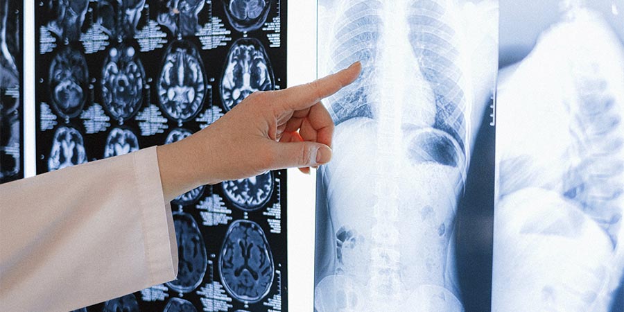 Qué es la artrosis facetaria