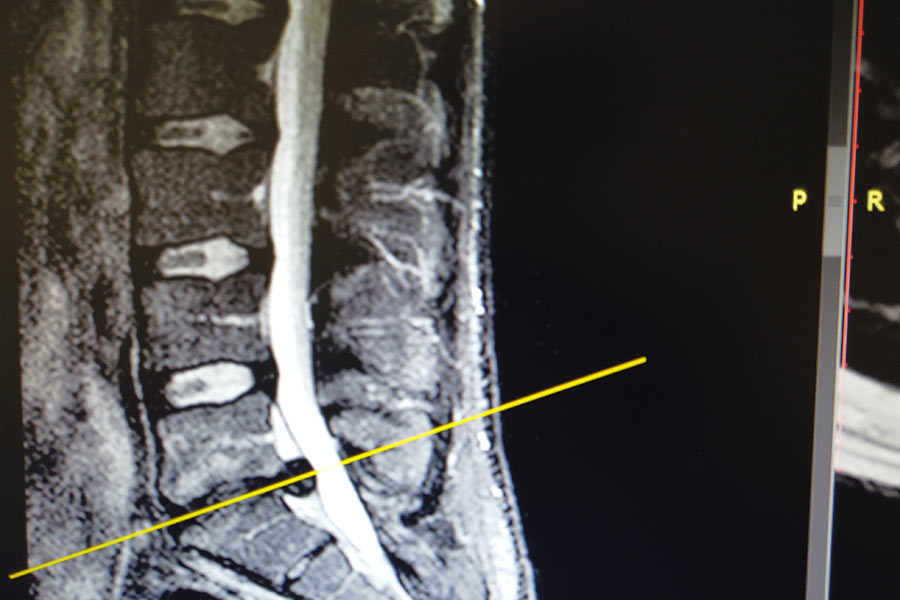 resonancia-hernia-l5s1-ciática-icac-2