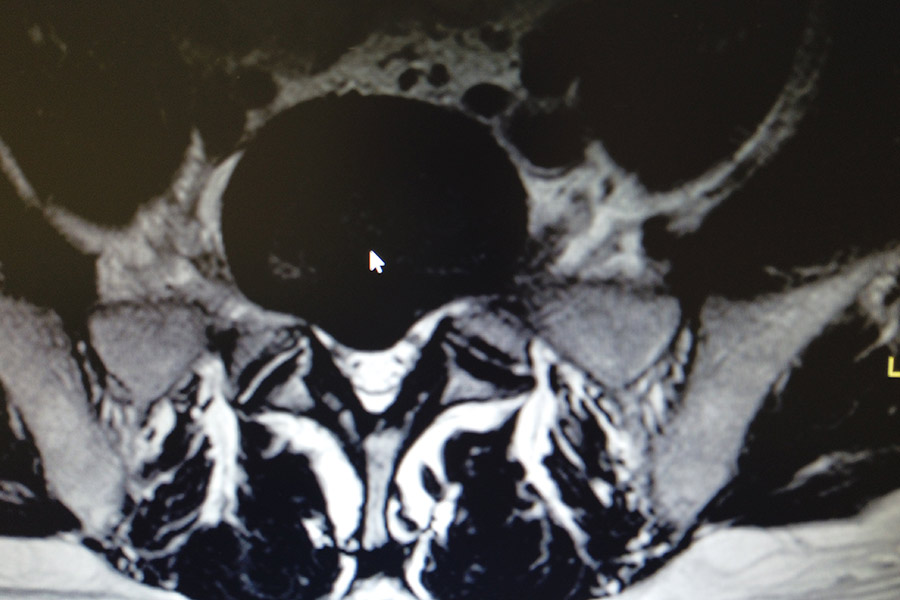 resonancia-hernia-l5s1-ciática-icac