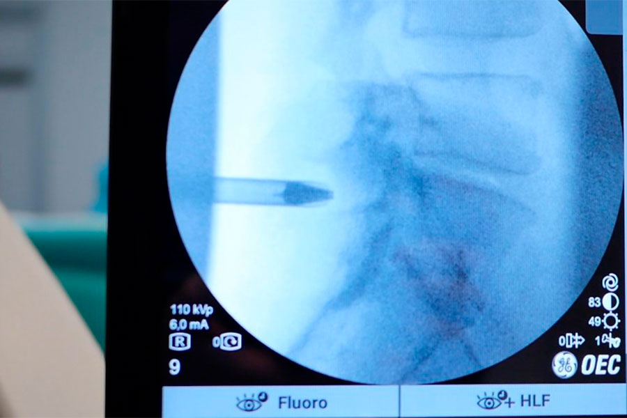 tratamiento-hernia-discal
