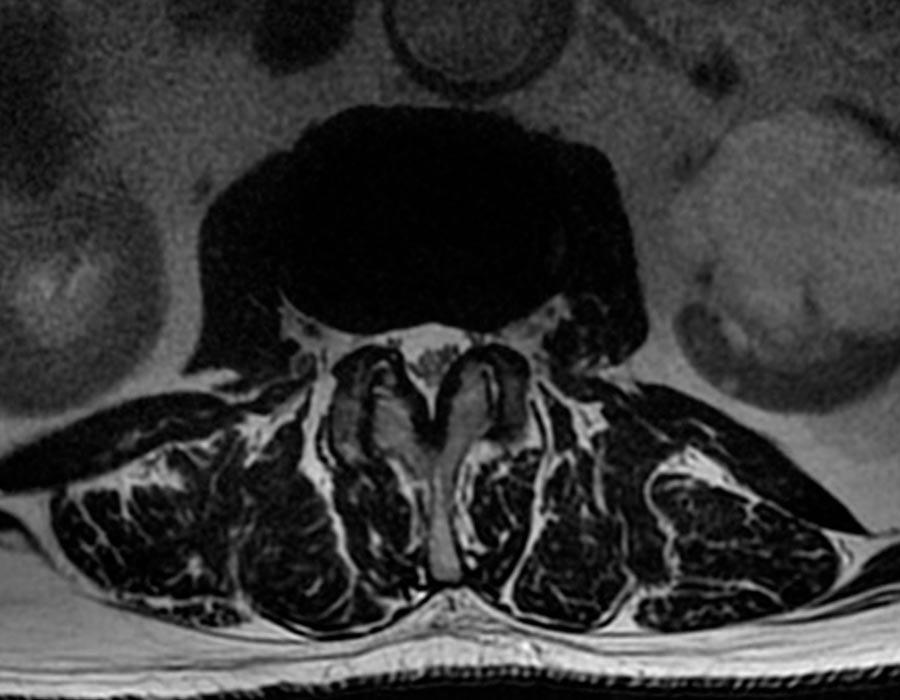 Vision transversal columna vertebral operacion