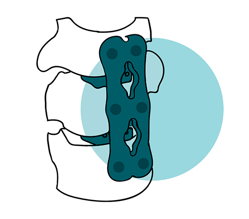 icono artrodesis cervical tratamiento columna
