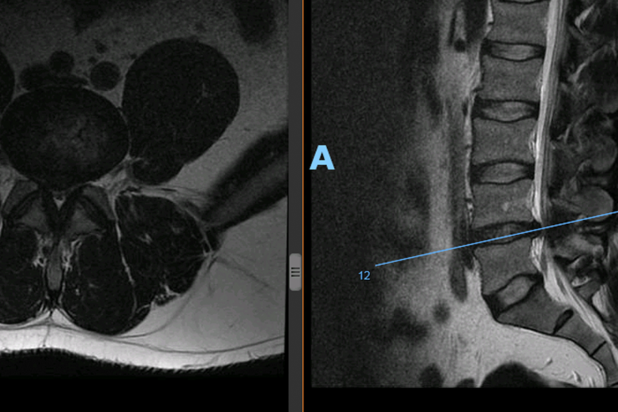 Resonancia con Hernia discal l4l5